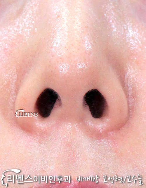 메부리코 매부리코 성형 수술 교정 휜코 처진 낮은 코끝 무보형물 성형 s967